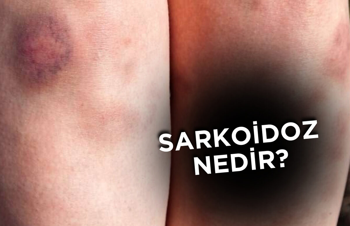 Sarkoidoz, vücudun çeşitli organlarında