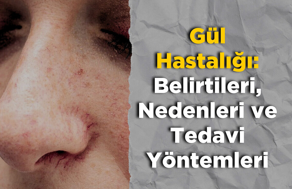 Gul Hastaligi Belirtileri Nedenleri ve Tedavi Yontemleri - Marmara Bölge: Balıkesir Son Dakika Haberleri ile Hava Durumu