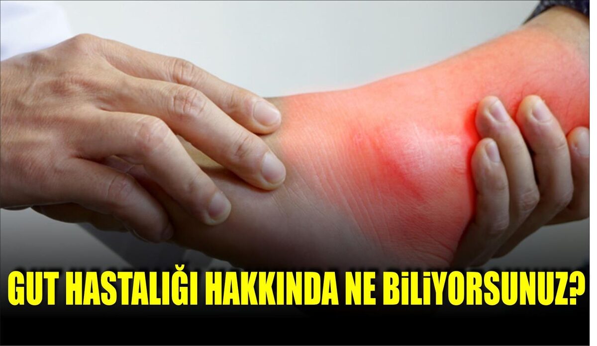 Gut, eklemlerde ağrı, şişlik,