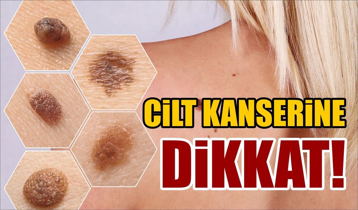 CİLT KANSERİNE DİKKAT!