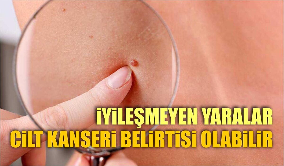 İYİLEŞMEYEN YARALAR CİLT KANSERİ BELİRTİSİ OLABİLİR  