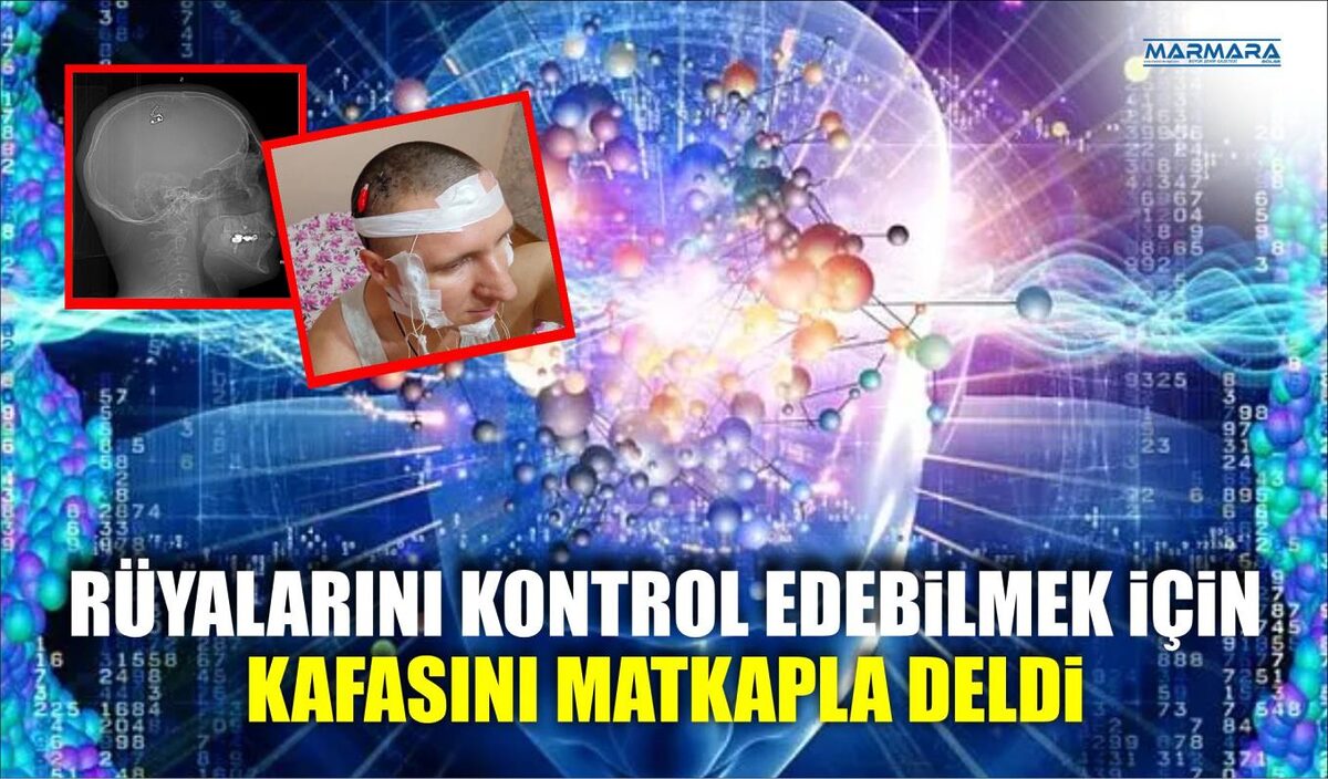 RÜYALARINI KONTROL EDEBİLMEK İÇİN KAFASINI MATKAPLA DELDİ  