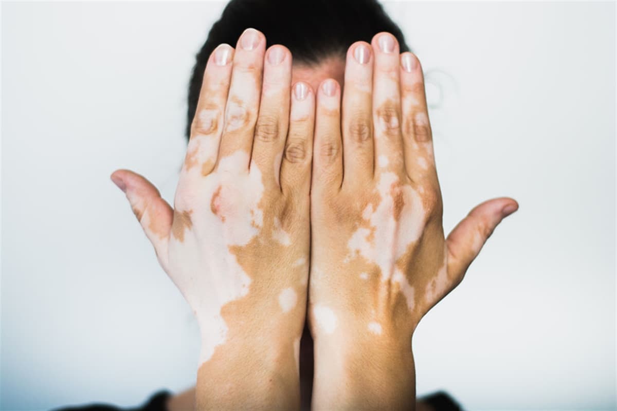 Vitiligo Hastalığı Nedir? Belirtileri ve Tedavi Yöntemleri Nelerdir?