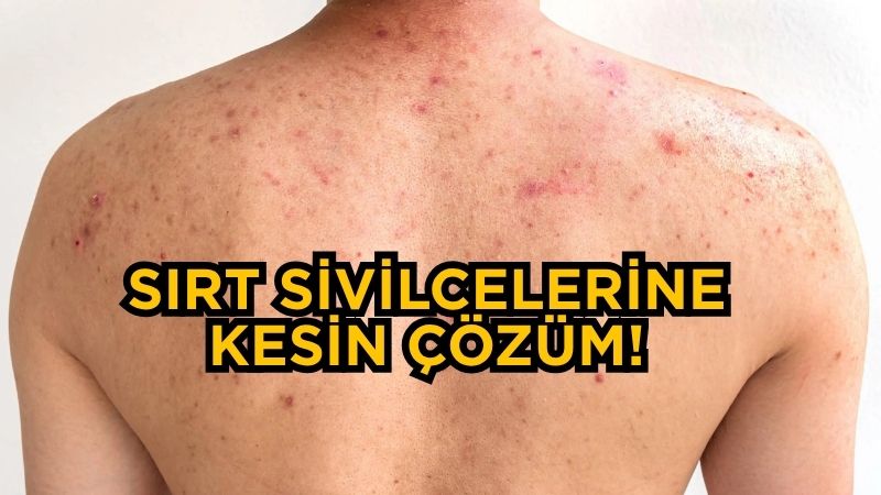 Yüzde çıkan sivilceler toplumun büyük kısmı tarafından bilinse de, kıyafetlerin