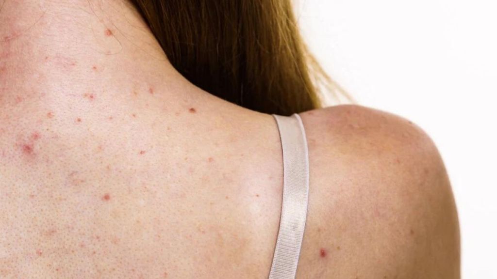 Sırt Sivilcelerine Kesin Çözüm! Sirt sivilcesi nedir - Marmara Bölge Gazetesi