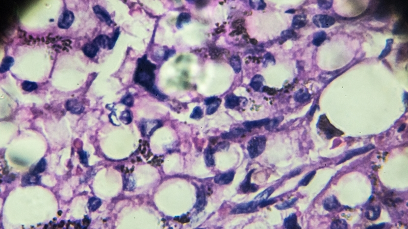 Sessiz İlerliyor, Organları Ele Geçiriyor : “Bu Bir Hastalık Değil, Alarmdır!” 3 10 - Marmara Bölge Gazetesi