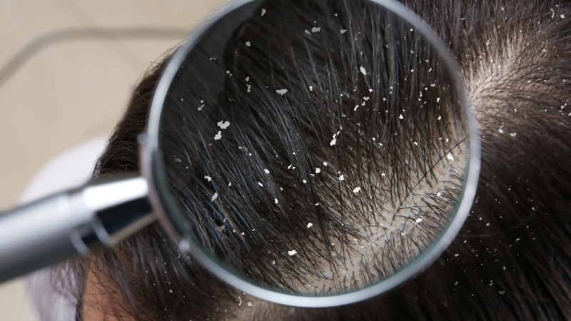 Saç derisindeki kepek ve kaşıntı sorununa Balıkesir’de uygulayabileceğiniz doğal yöntemlerle