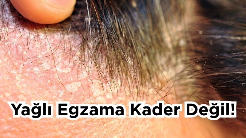 Dermatoloji Uzmanı Dr. Ezgi Özkur, YouTube kanalında yayınladığı son videosunda