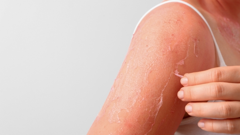 Her Yanık Cildinizi Sessizce Yaşlandırıyor! Adsiz tasarim 1 140 - Marmara Bölge Gazetesi