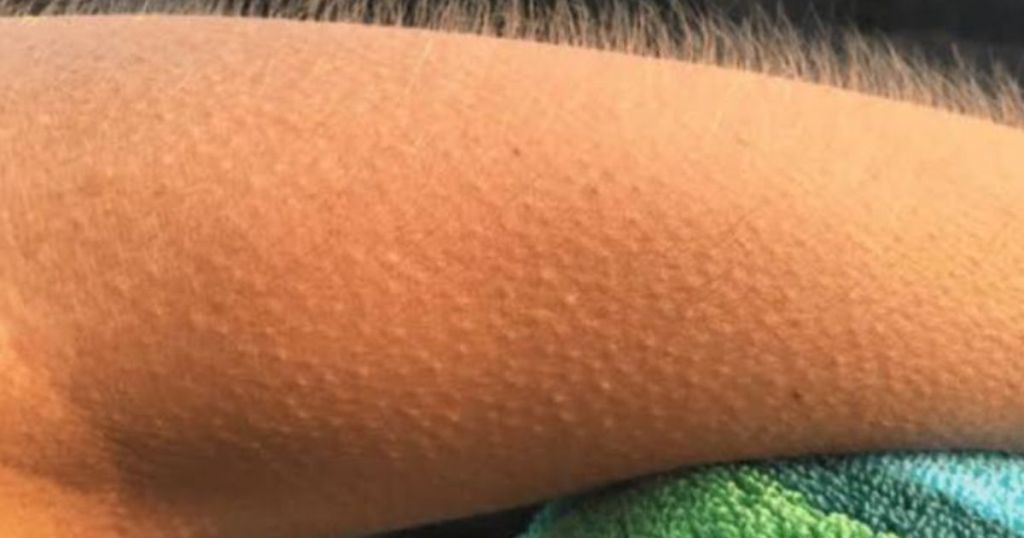 Soğuk havalarda ya da korku anlarında yaşanan “tüylerin diken diken