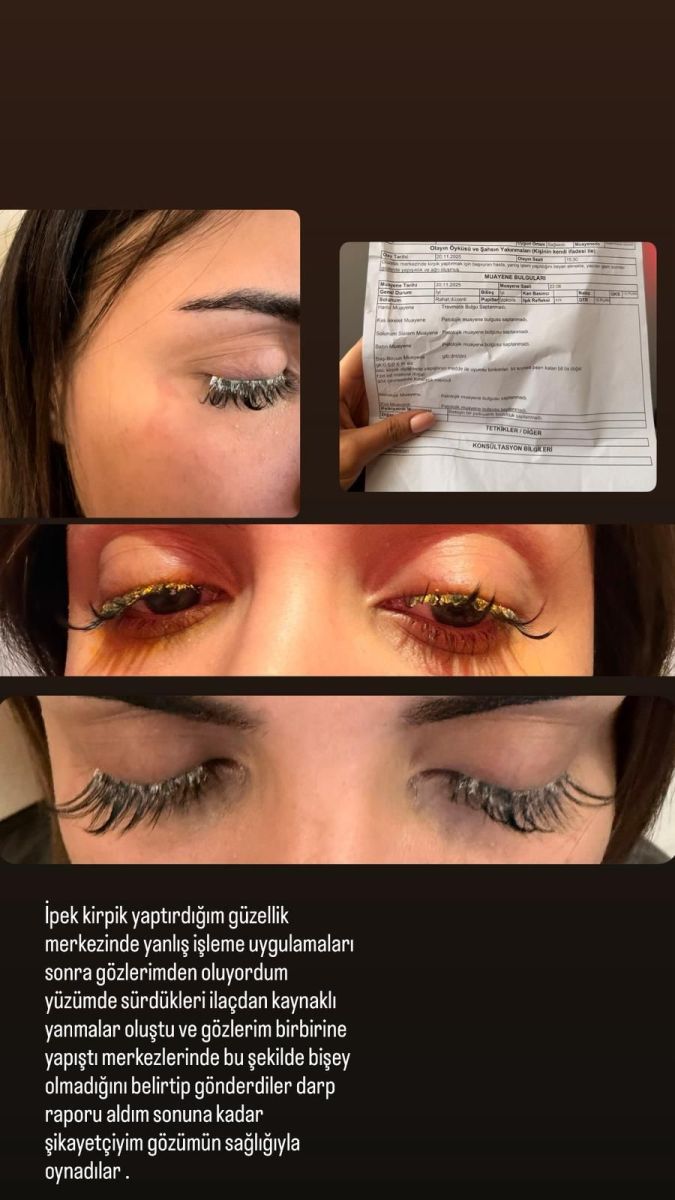 Güzellik Salonunda Gözüne Yapıştırıcı Kaçtı, Kısmi Kör Oldu! AW584387 02 - Marmara Bölge Gazetesi