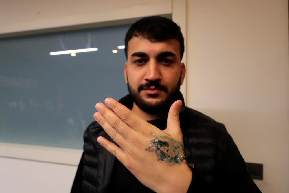 Dövme Sildirme Seansı Kabusa Döndü: Elinde İkinci Derece Yanık Oluştu! AW613579 01 - Marmara Bölge Gazetesi
