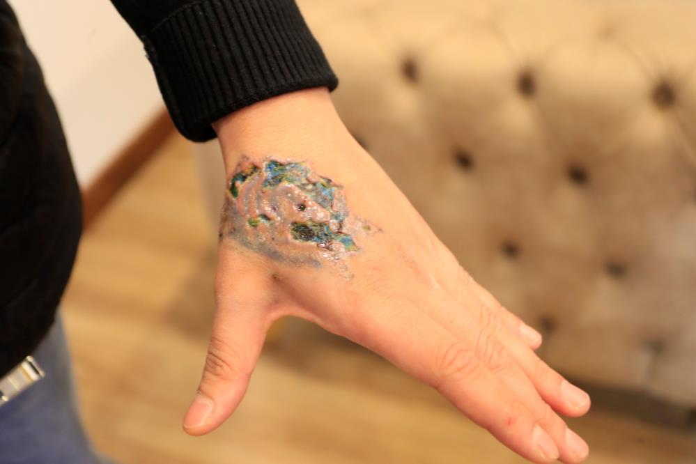 Dövme Sildirme Seansı Kabusa Döndü: Elinde İkinci Derece Yanık Oluştu! AW613579 03 - Marmara Bölge Gazetesi