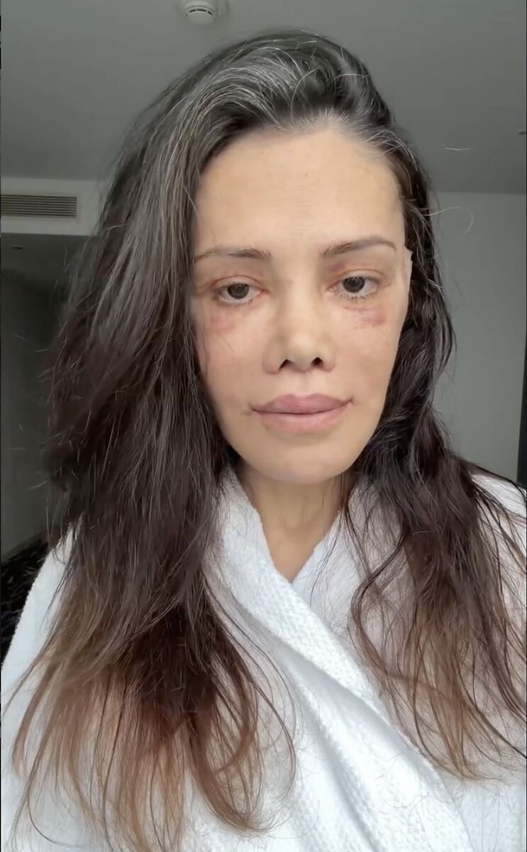 Yüz Nakli Geçiren Didem Ceran'ın Yüzündeki Komplikasyon Şaşırttı! s 96af06d052a2ae993bea9e8c600c25f516f02cbc - Marmara Bölge Gazetesi