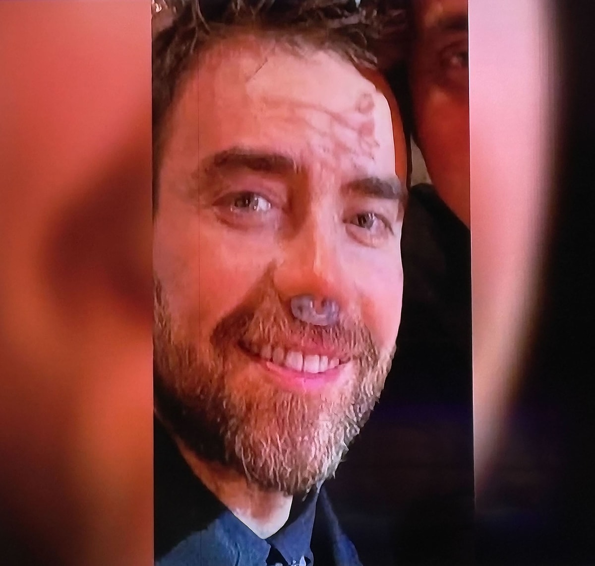 13 Kez Burun Ameliyatı Olan Murat Dalkılıç’ın Son Hali Olay Oldu s d78387b6219a0c2b819adcb91ddee4688fef7a24 - Marmara Bölge Gazetesi