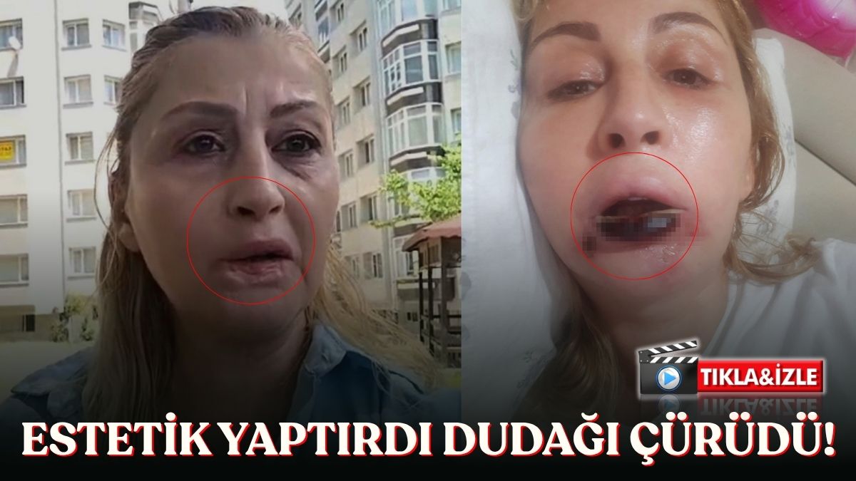 Antalya'da estetik işlem sonrası dudağında doku kaybı oluştuğunu öne süren