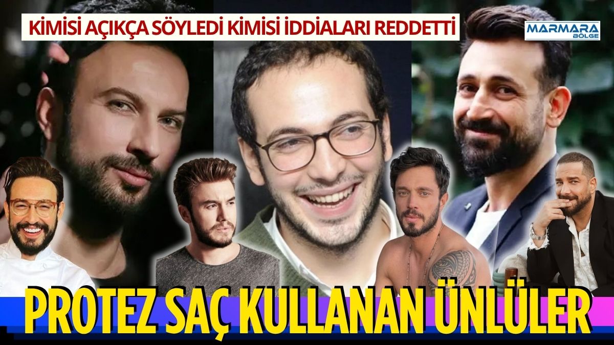 Saç ekimi, protez saç ve kişiye özel saç sistemleri, ünlüler