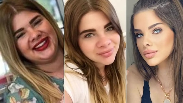 Estetik Yaptırıp Değişimleriyle Gündem Olan Ünlüler s ad5d1256c1819a5dac3f2b25eabeb422f66640e2 - Marmara Bölge Gazetesi
